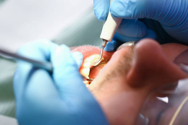 Best Emergency Dentist for Knocked-Out Tooth in Avery Creek, NC
