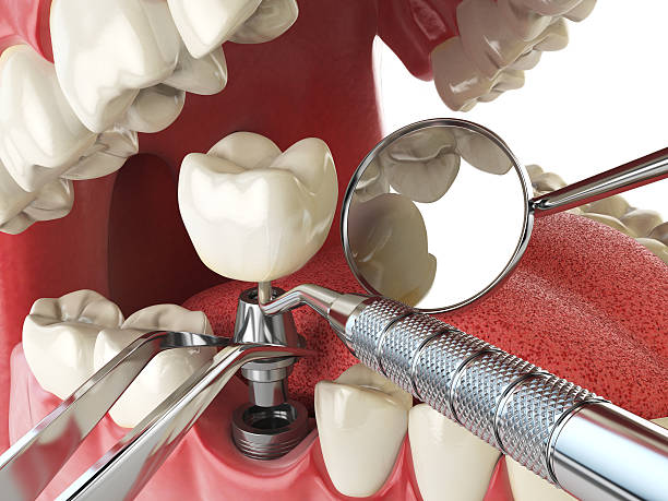 Best Emergency Dental Extractions in Avery Creek, NC